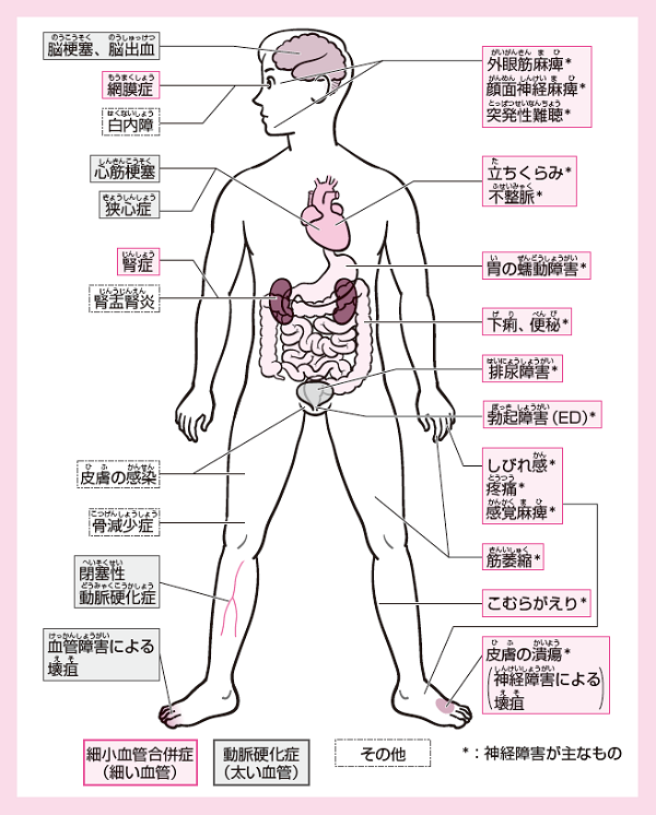 糖尿病の合併症は全身に出る